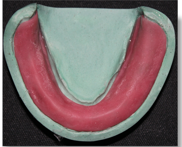 Step by step Guide for Understanding the Prosthodontics Complete