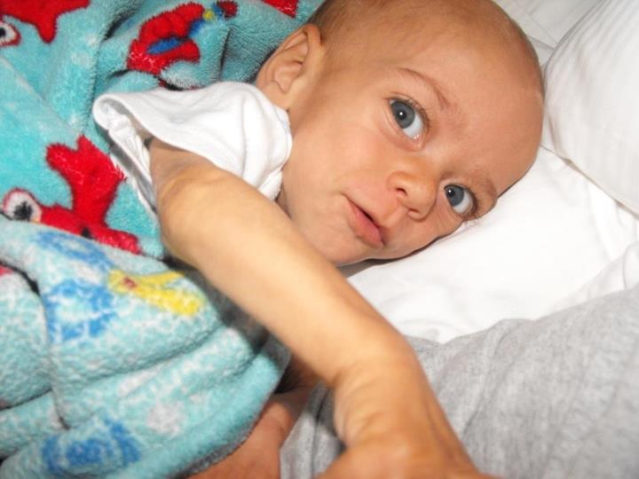 NiemannPick Disease, Type B