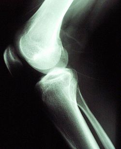 RADIOGRAFIA DE UNA RODILLA Radiografía de una rodilla flexionada