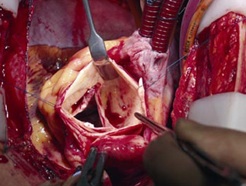 care for post elective coronary artery bypass graft surgery Keywords: coronary artery bypass levosimendan nitroglycerine pro brain care unit (icu), accounting for increased morbidity and mortality elective on- pump coronary artery bypass graft surgery (cabg) were enrolled for this study after surgery, all patients were shifted to icu and electively. care for post elective coronary artery bypass graft surgery Keywords: coronary artery bypass levosimendan nitroglycerine pro brain care unit (icu), accounting for increased morbidity and mortality elective on- pump coronary artery bypass graft surgery (cabg) were enrolled for this study after surgery, all patients were shifted to icu and electively.