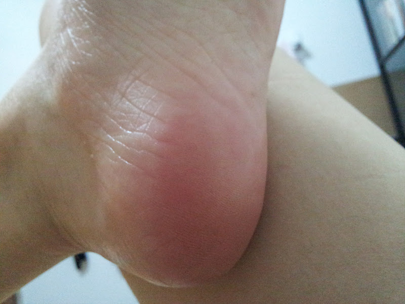 My Heel Hurts