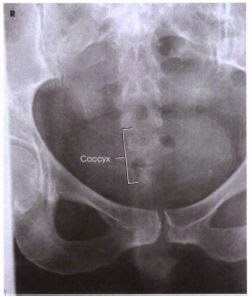 coccyx radiograph with label