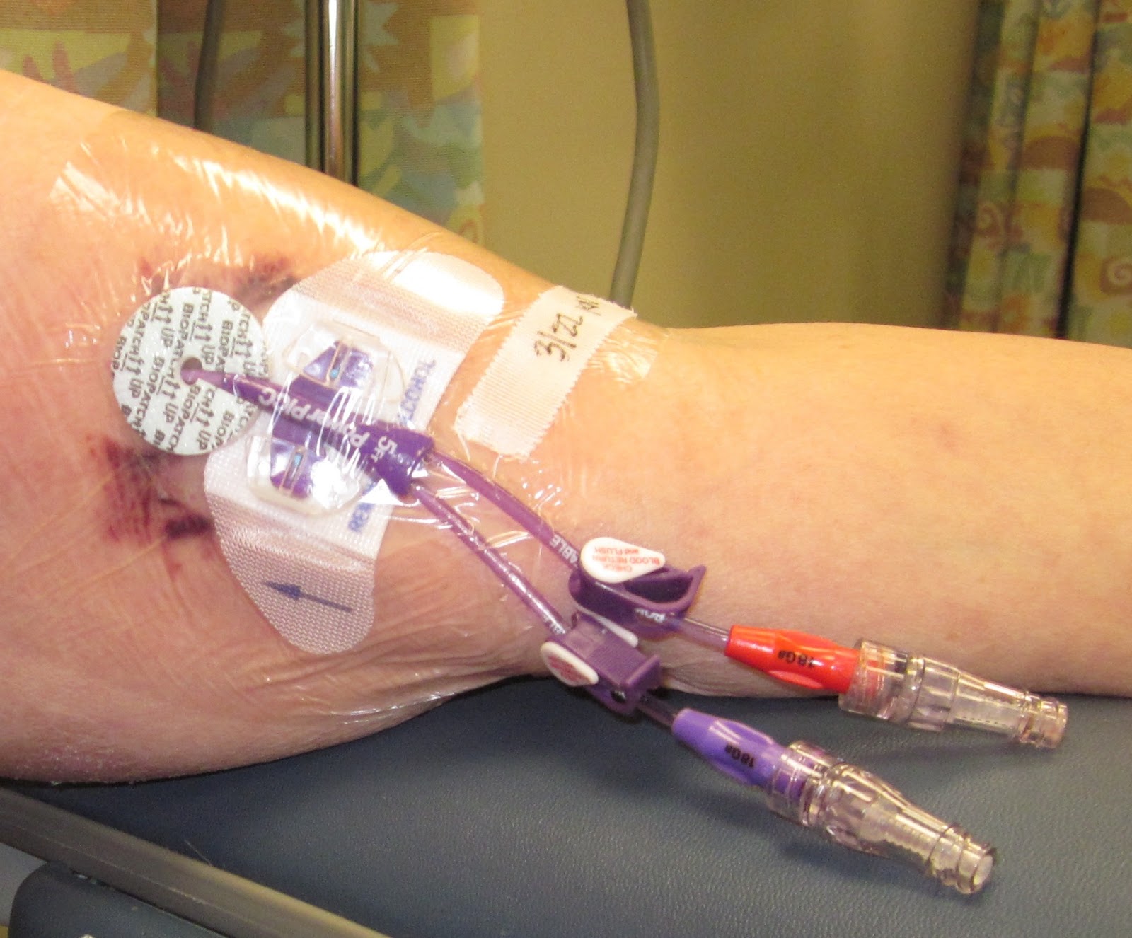jm's Adventure with Multiple Myeloma PICC Line Dressing Change and