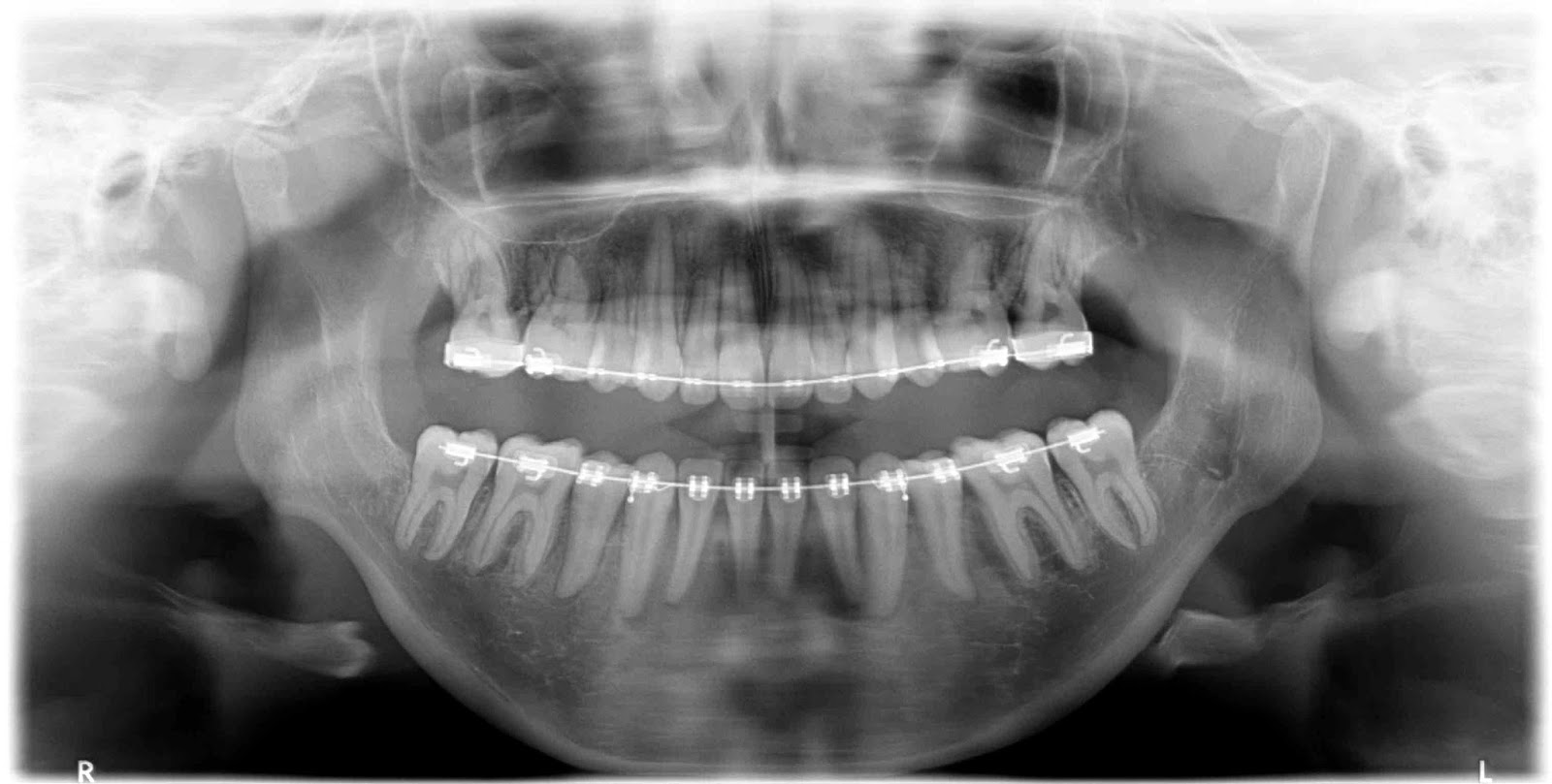 Double Jaw Surgery Journey PreSurgery XRays