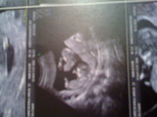 Ecografía de gemelos Ecografía de gemelos