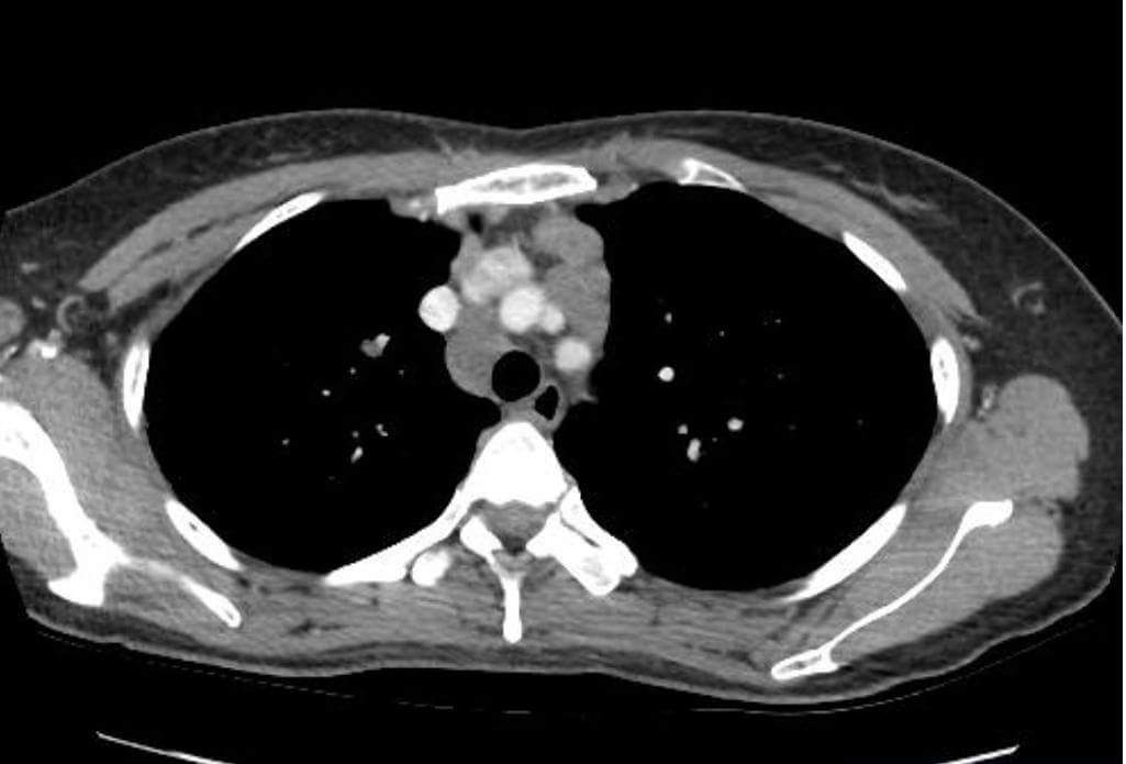 sarcoidosis chest ct radiology