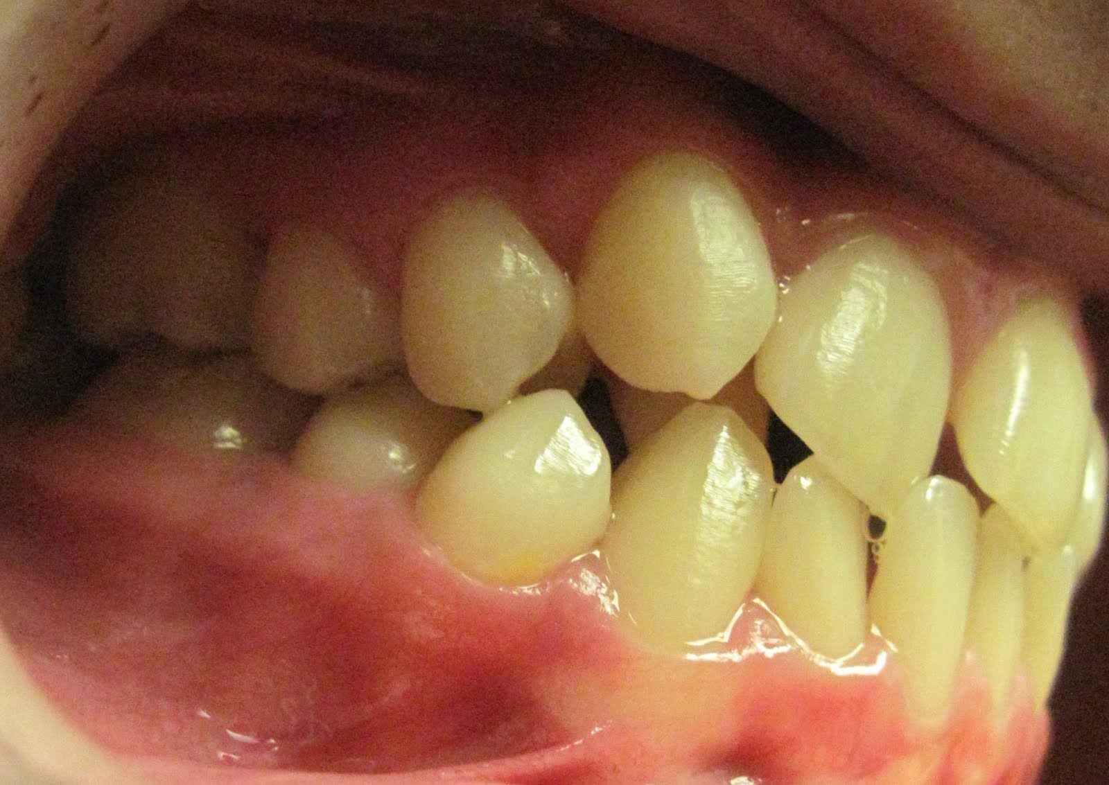 practical orthodontics Anterior labial root torque