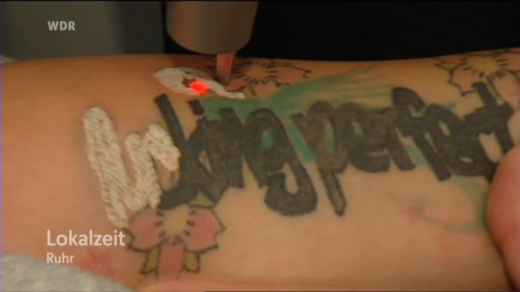 Laser entfernt ungeliebte Tattoos ( Lokalzeit Ruhr ) Lokalzeit Junkie
