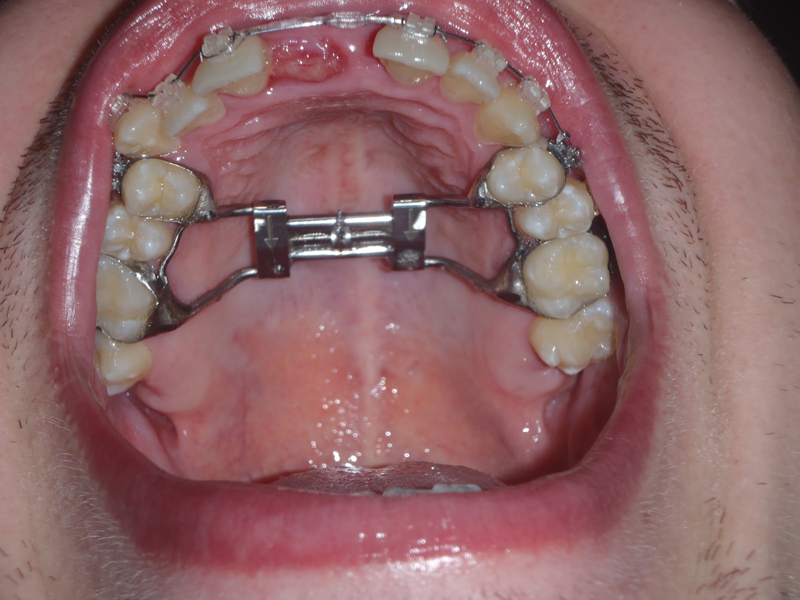 My SARPE Story Stalemate Braces vs The Expander!