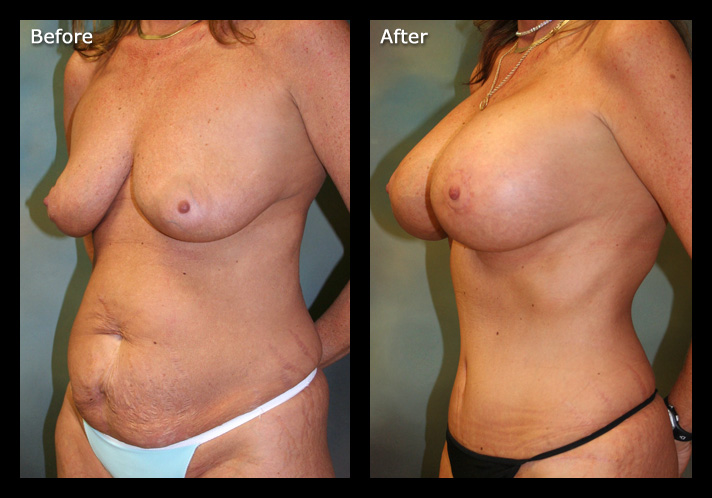 pictures of breast implant sizes milfs accross the world group sex