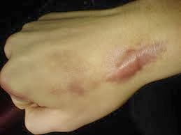 Picture of Keloid
