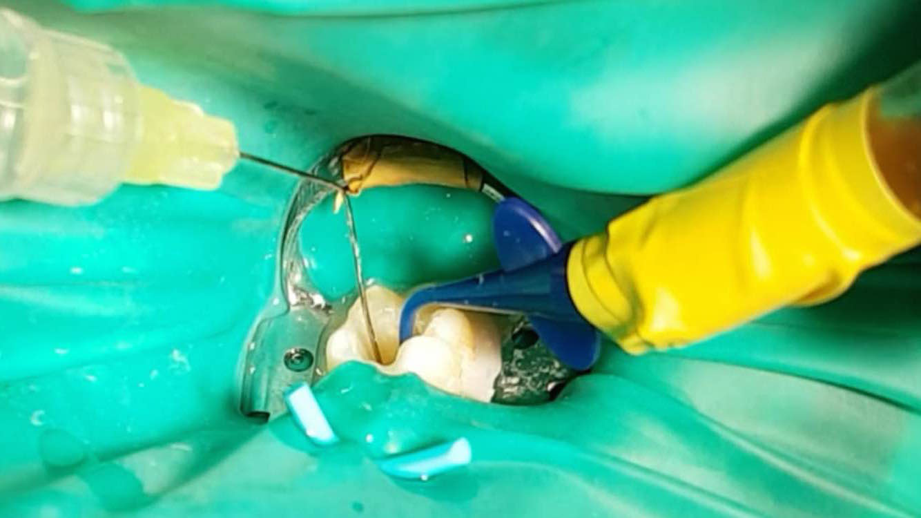 Irrigantes para endodoncia