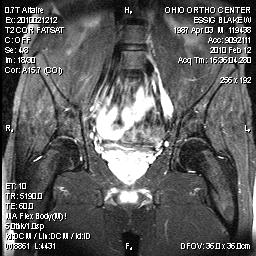 Lumbar Plexus Mri