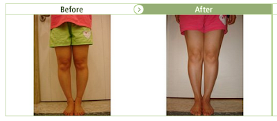 causes of bowlegs, bowlegs problems, bowlegs reasons causes of bowlegs, bowlegs problems, bowlegs reasons