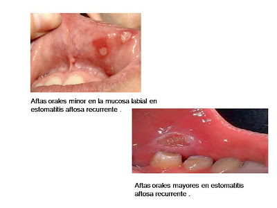 Aftas orales