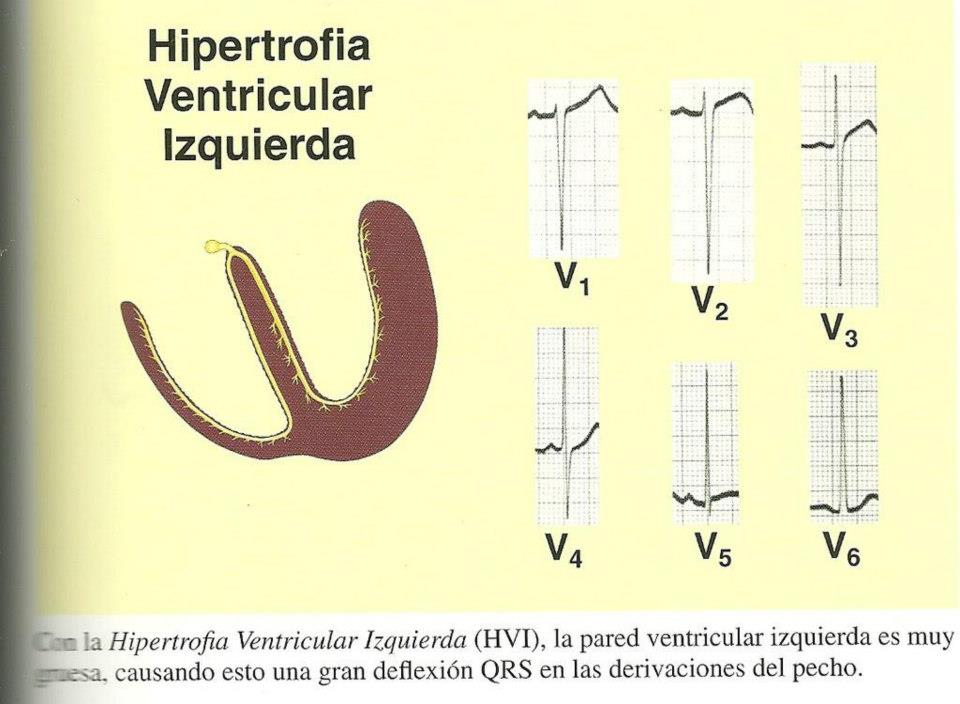Electrocardiograma Hipertrofia ventricular izquierda