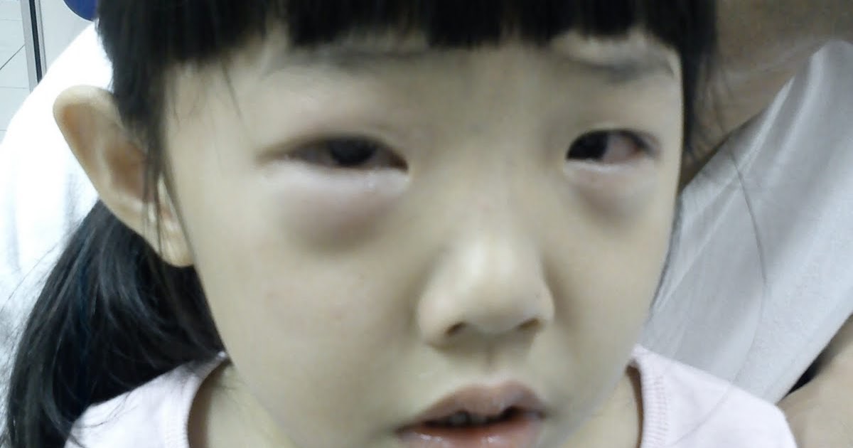 Ramblings Allergy Attack