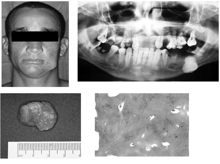 Osteoma Diagnóstico en patología bucal.