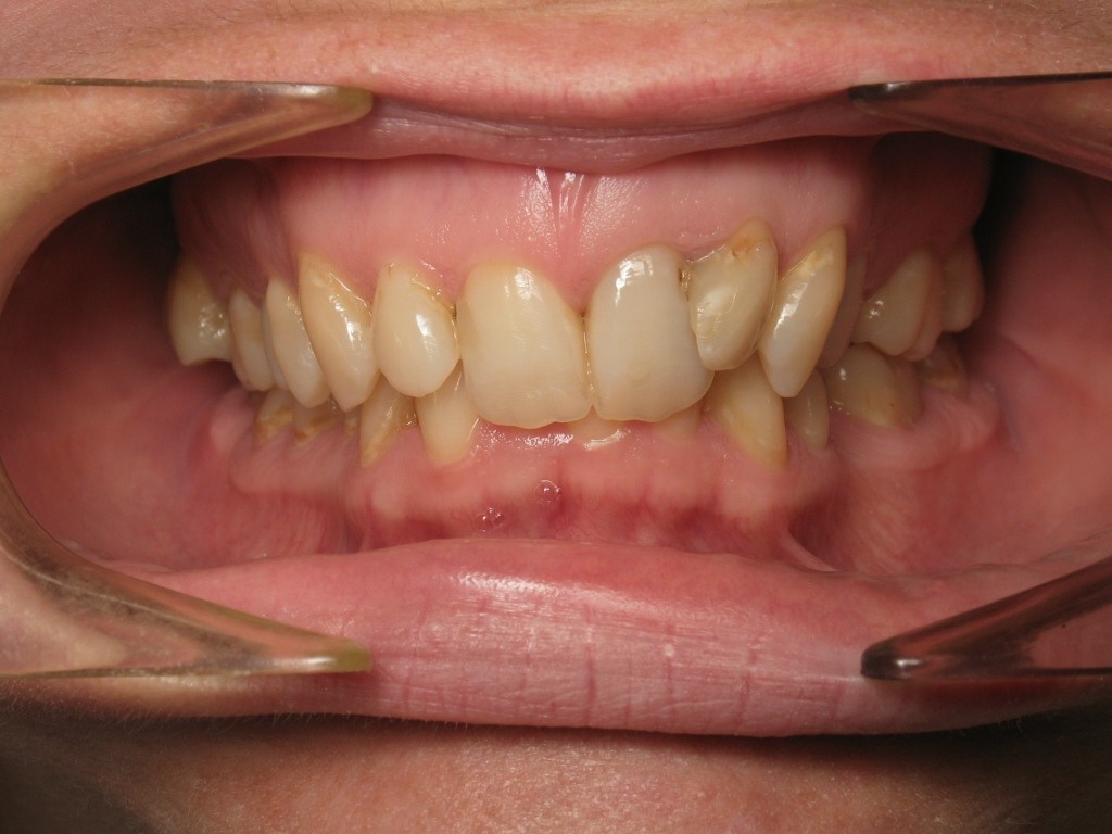 braces before august harmony lingual unhappy squished jaw
