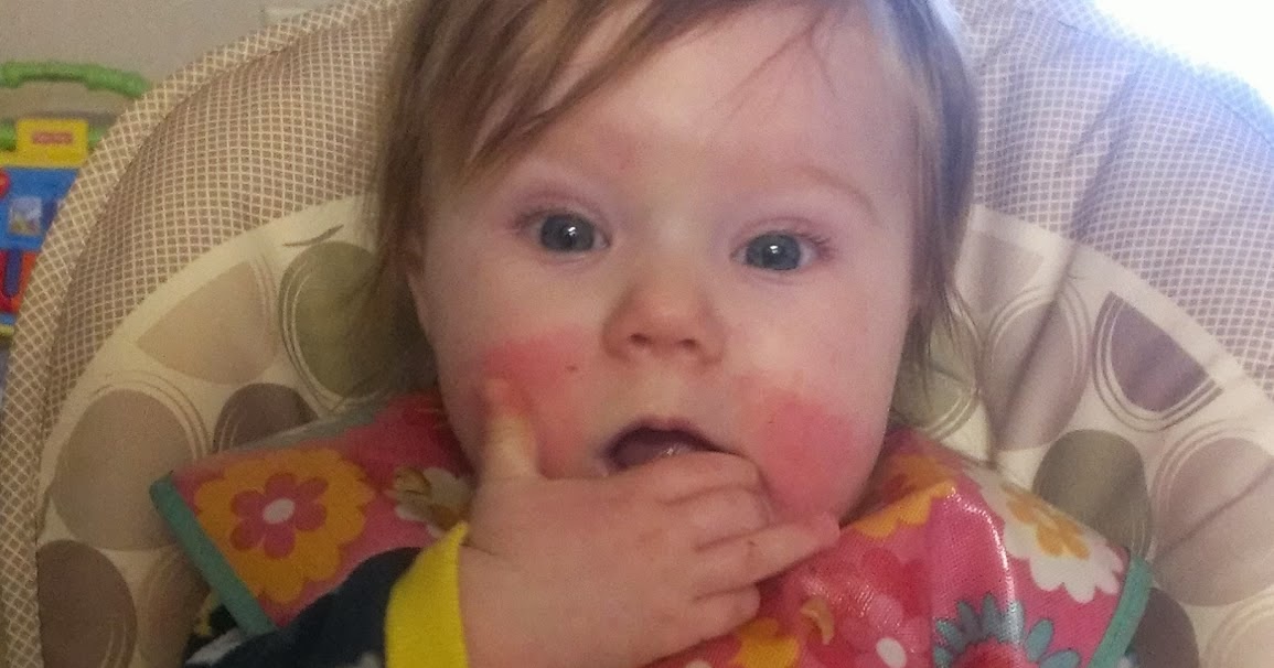 Our Family Beginnings Allergic Reaction to Cottage Cheese