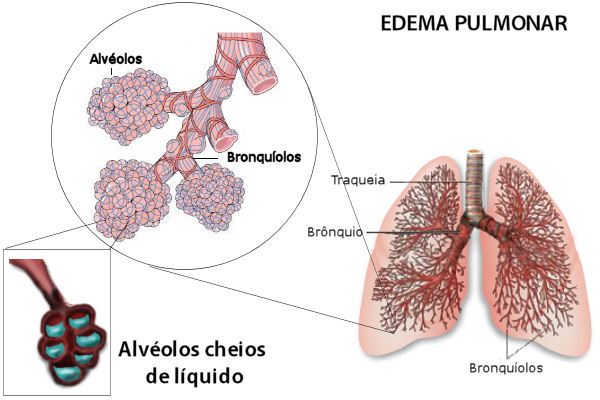 Resultado de imagem para edemas pulmonares