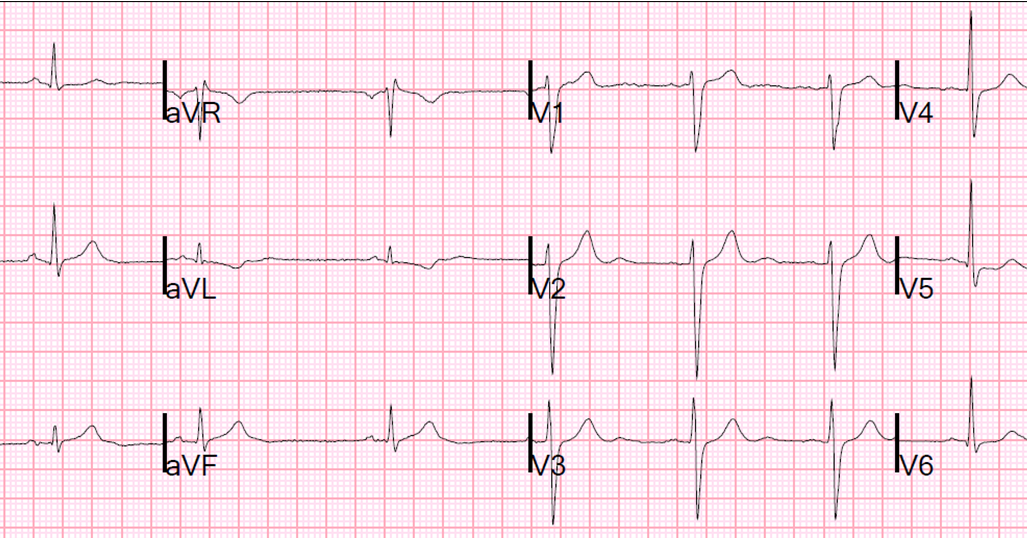 Dr. Smith's ECG Blog ED Bedside Echo for the last very subtle inferior