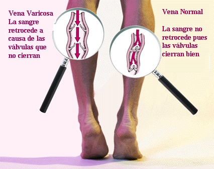 La trombosis de las venas de las extremidades inferiores a los recién nacidos