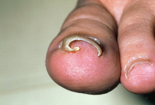 Mild Toenail Infection