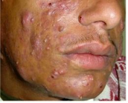 exposed acne treatment