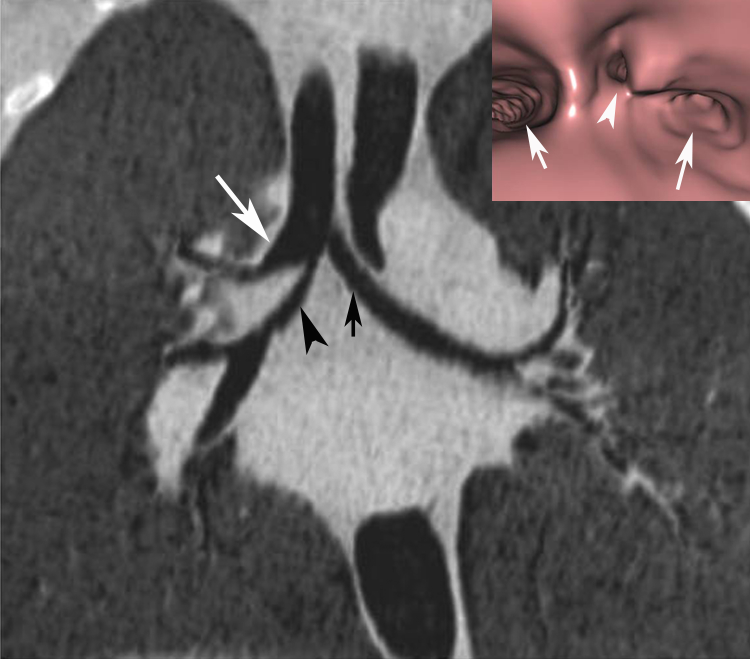 Radiodiagnosis Imaging is AmazingInteresting cases Tracheal