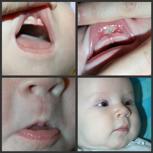 Tongue Tied Infant Upper Lip