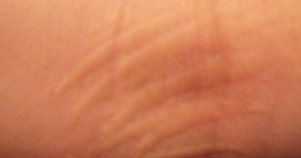 The GRAY Area Stop The Itch of Contact Dermatitis