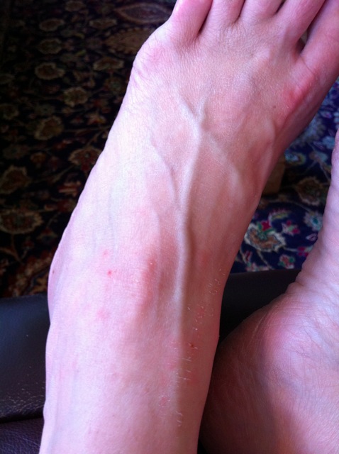 chiggers come feet chigger dogs bugs lines outside colors plant