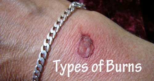 what names are given to the three different types of burns