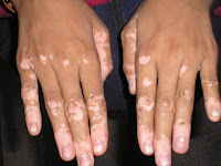 vitiligo-hands.jpg