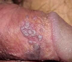 Penyakit Herpes Kelamin Penyakit Herpes Kelamin