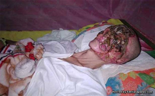 Ngeri Muka Hilang Dimakan Virus Misteri Huynh Van Dat