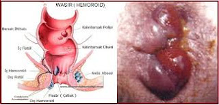 Obat Wasir Untuk Menyusui Obat Wasir Untuk Menyusui