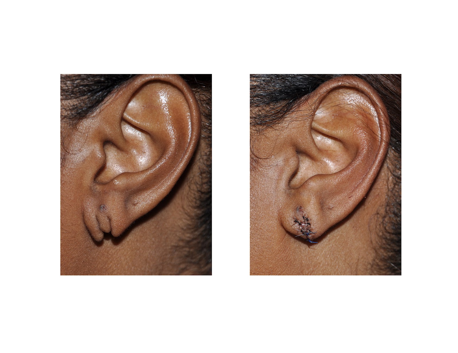 DAILY MAYHAM! EARLOBE REPAIR!