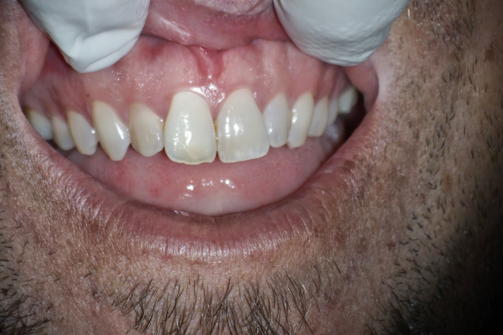 The Endo Blog Internal Bleaching of VITAL Teeth