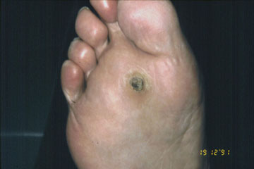 Plantar warts can be far more