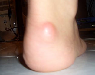 Heel Spur