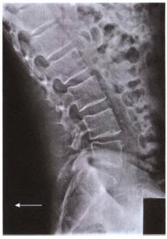 Spinal Fusion series hyperextension radiograph