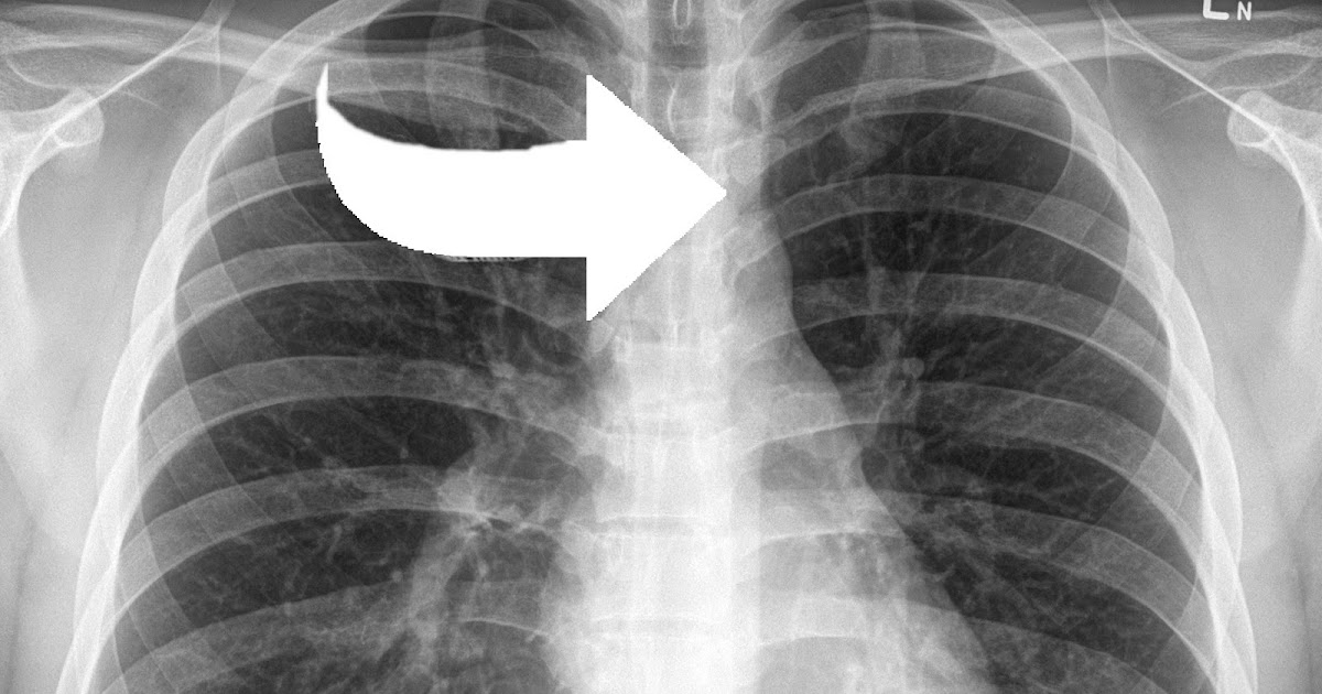 Dr. Grimes' Bottom Line Chest Pain in a Teen or TwentySomething?