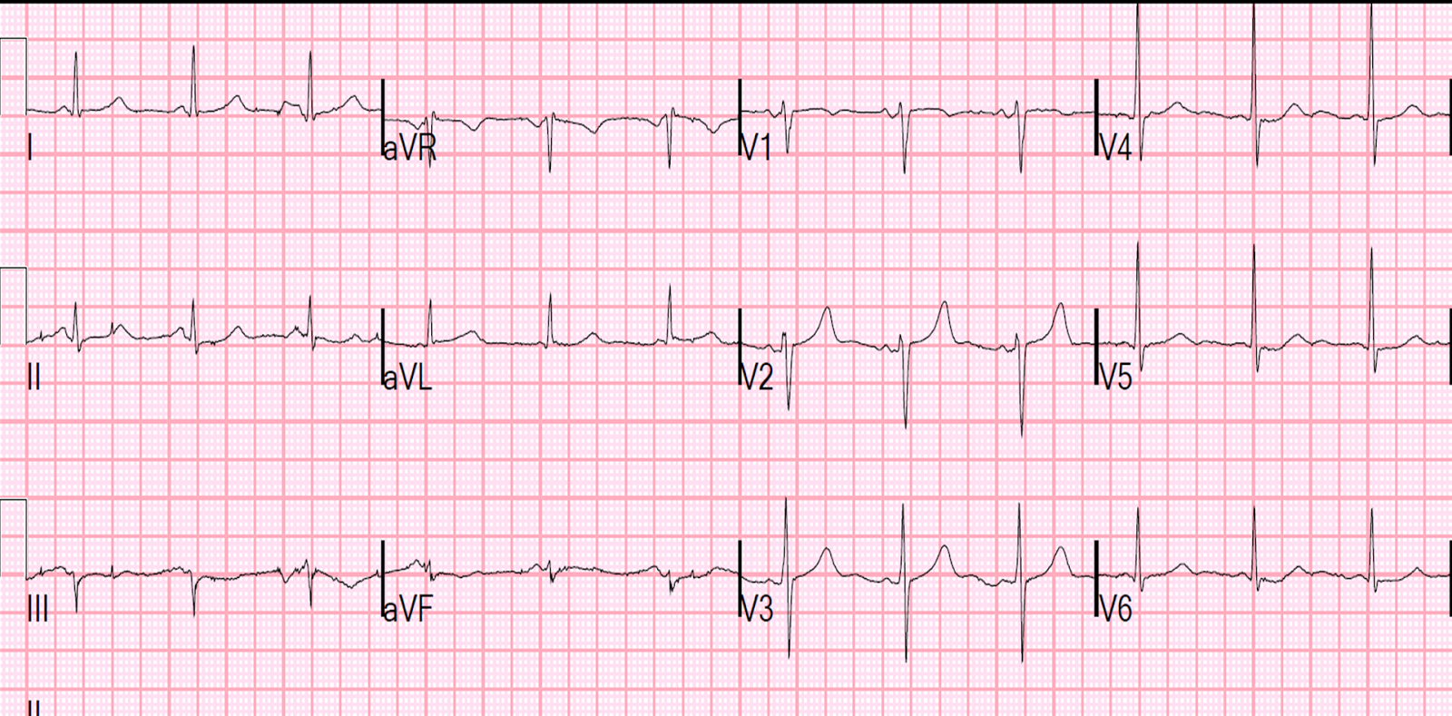 Dr. Smith's ECG Blog: A 50-something with severe chest pain and a