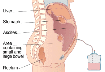 Eye Paracentesis Procedure