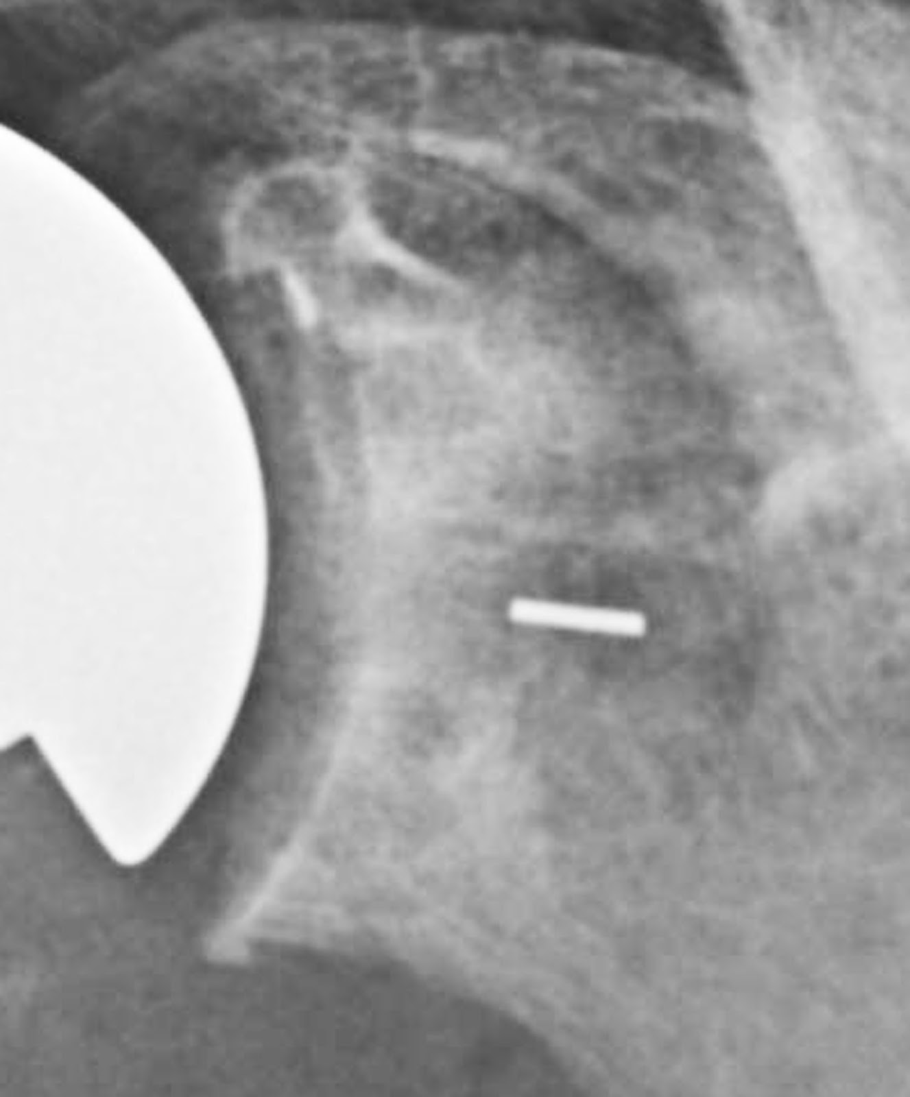 Shoulder Arthritis / Rotator Cuff Tears causes of shoulder pain Total