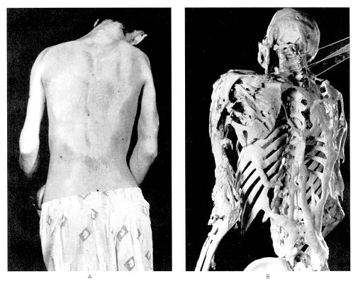 fibrodysplasia ossificans progressiva Fibrodysplasia ossificans progressiva (fop) is a rare and disabling genetic condition characterized by congenital malformations of the great toes and. fibrodysplasia ossificans progressiva Fibrodysplasia ossificans progressiva (fop) is a rare and disabling genetic condition characterized by congenital malformations of the great toes and.