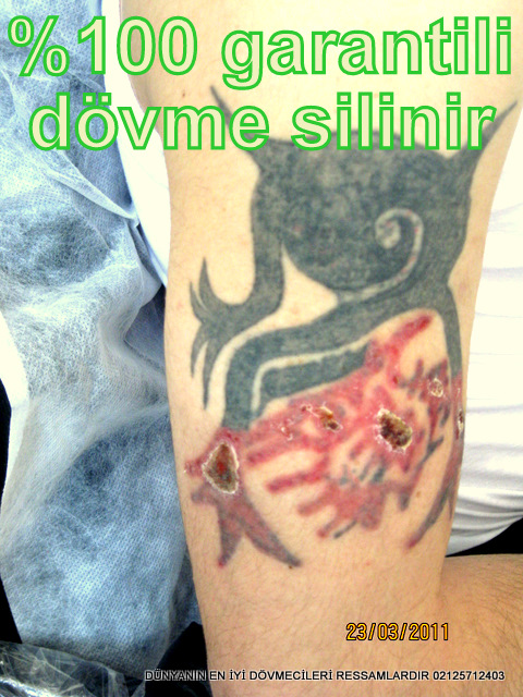 Dovme Silme Dovme Silme Yontemleri