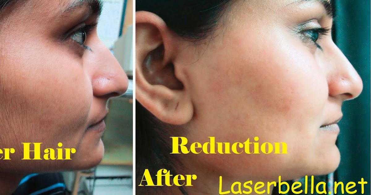 Laserbella,Hair Removal Laser Hair Removal Pros & Cons Laserbella